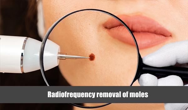 Radiofrequency removal of moles