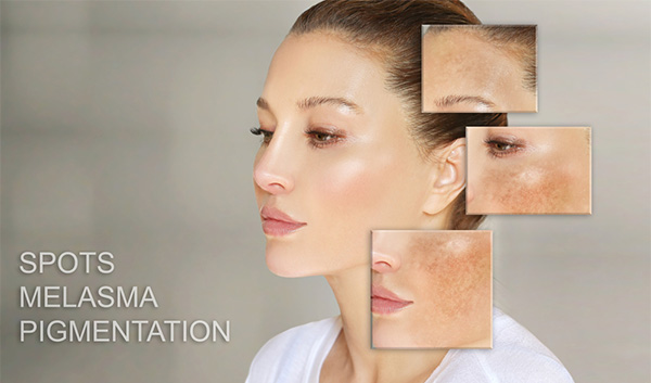 treatment Melasma