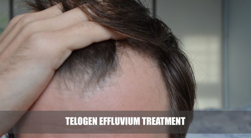 Telogen Effluvium treatment