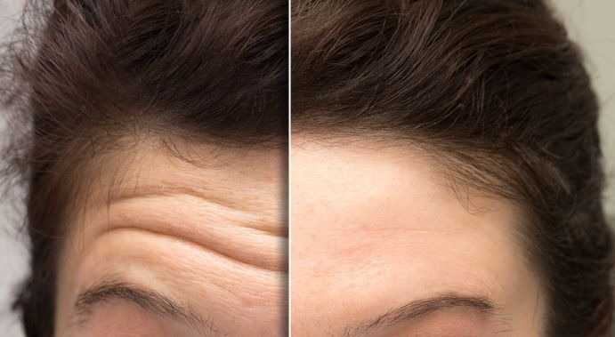 Best Botox Treatment in Thane with Latest Prices