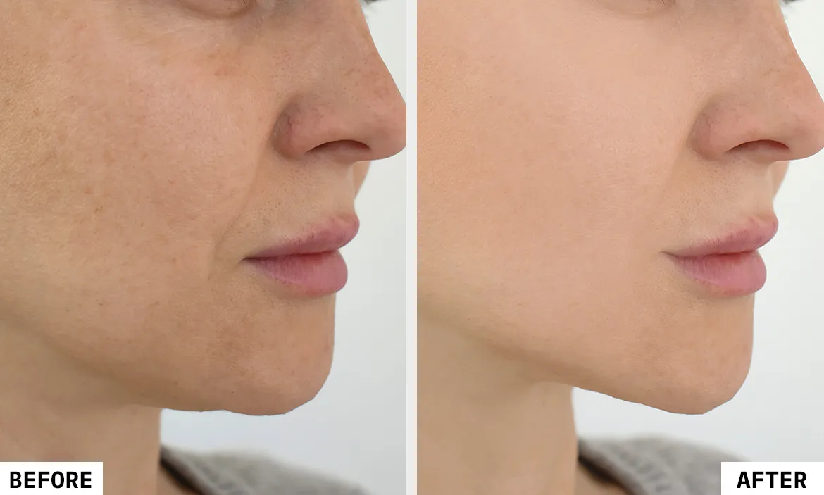 hifu treatment in Mumbai by Dr. Manish Ratnakar
