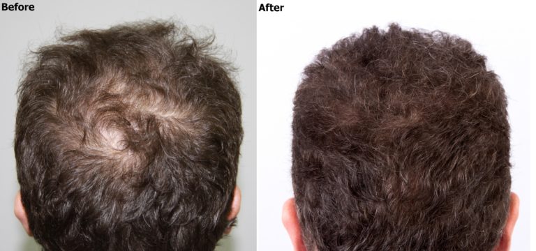 Benefits of Exosome Therapy for Hair Restoration in Mumbai By Dr. Manish Ratnakar