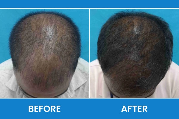 GFC Treatment and Benefits for Treating Hair Loss in Thane