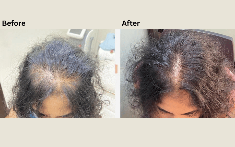 GFc treatment Before after Results