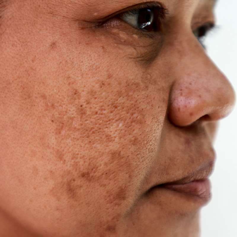 Reducing Melanin