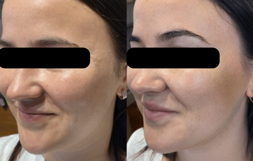 Who Should Avoid Anti-Aging Injections?