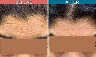 Cost of Anti-Aging Injections in Mumbai