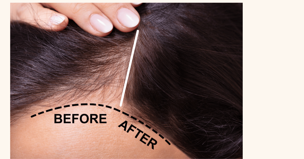 haie PRP treatment Mumbai