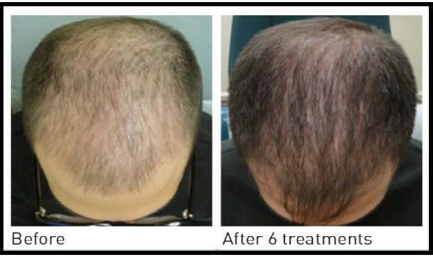 what-is-hair-PRP-treatment