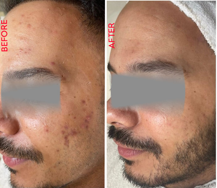 Acne Treatment Before and After Images Thane