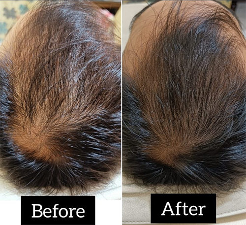 Hair Growth PRP Treatment Results
