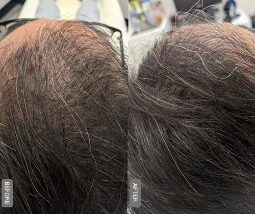 Hair PRP Treatment Before and After Thane