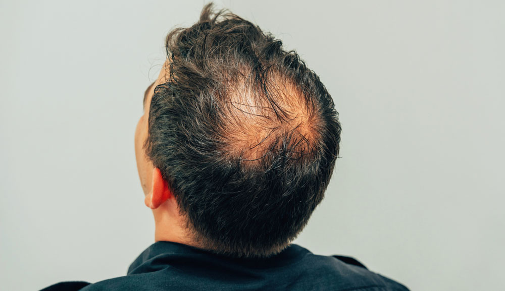 Hair loss  Symptoms and causes  Mayo Clinic