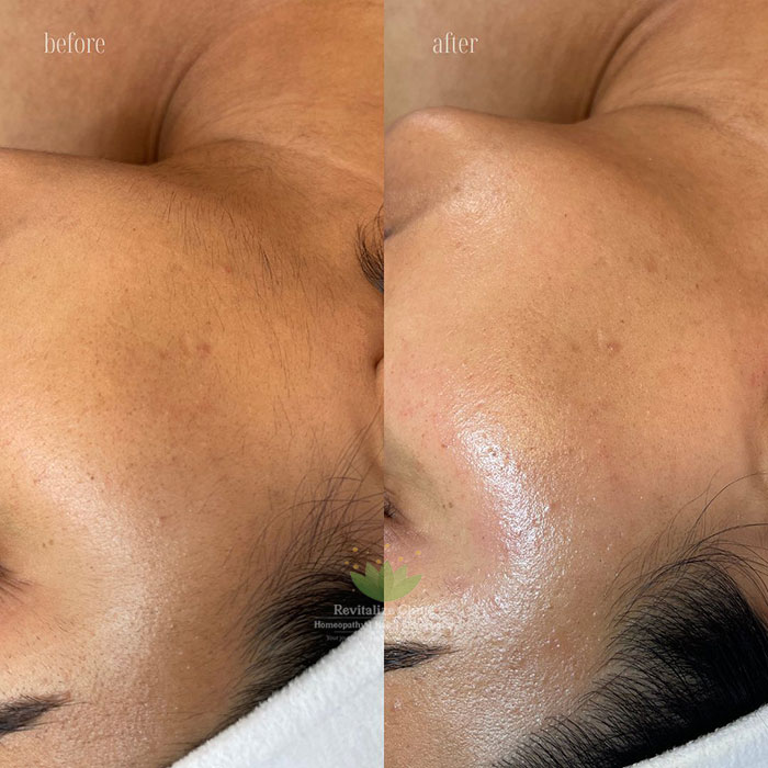 Laser Hair Removal Before and After
