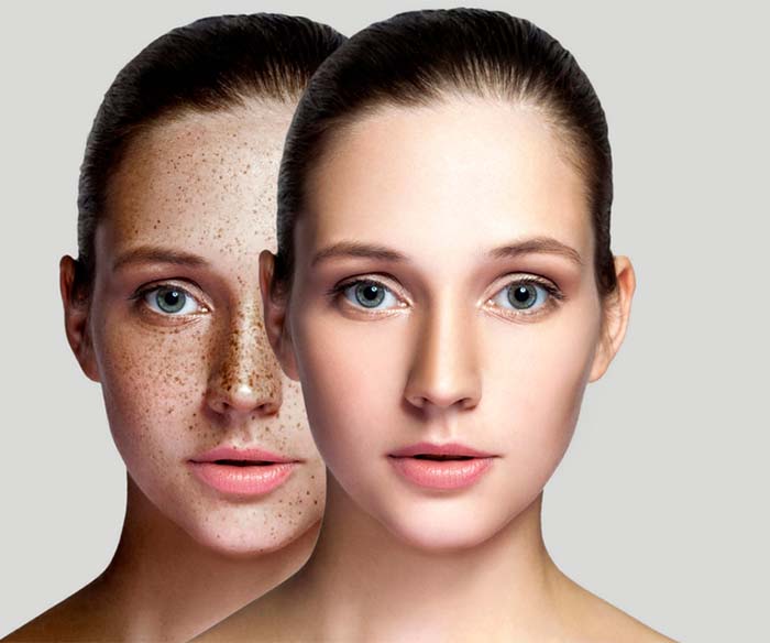 anti-Pigmentation-treatment