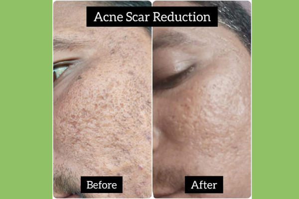 acne-scar-treatment-before-after