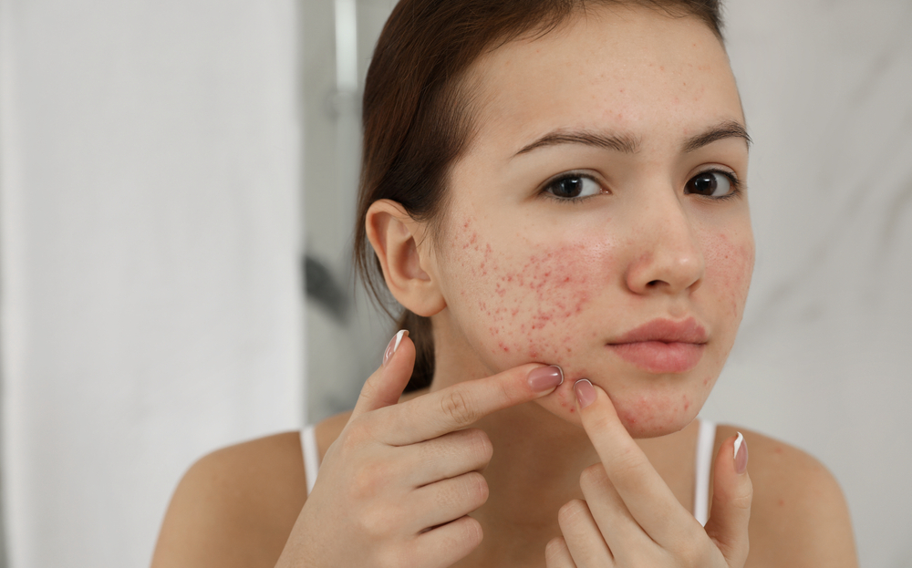 acne-treatment