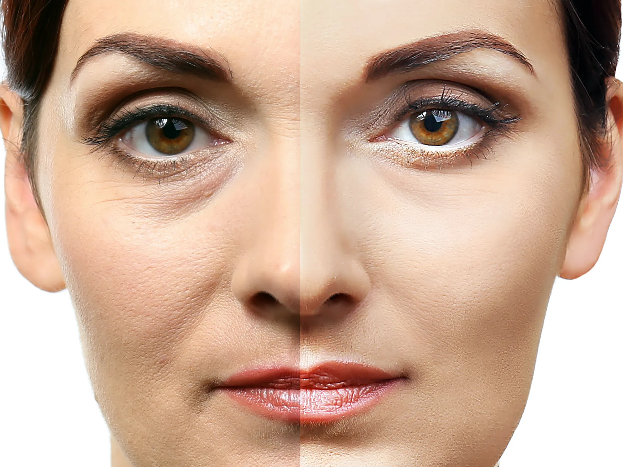 anti wrinkle botox treatment