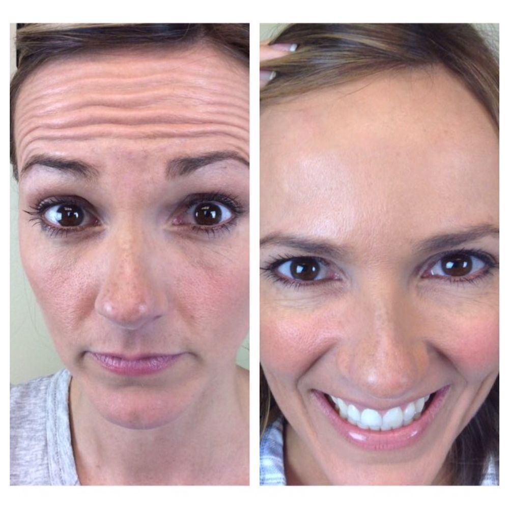 Radiofrequency skin tightening treatment in Thane