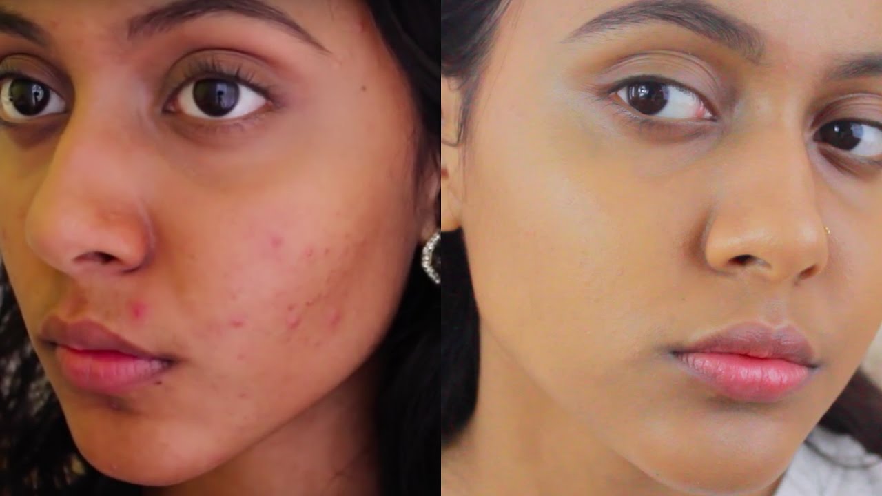 Acne Scar Treatment Before and After